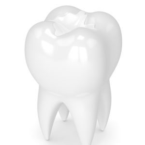 3d render of tooth with dental composite filling over white background