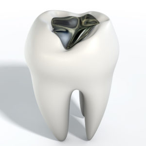 A lead cavity filling on a single molar on an isolated background