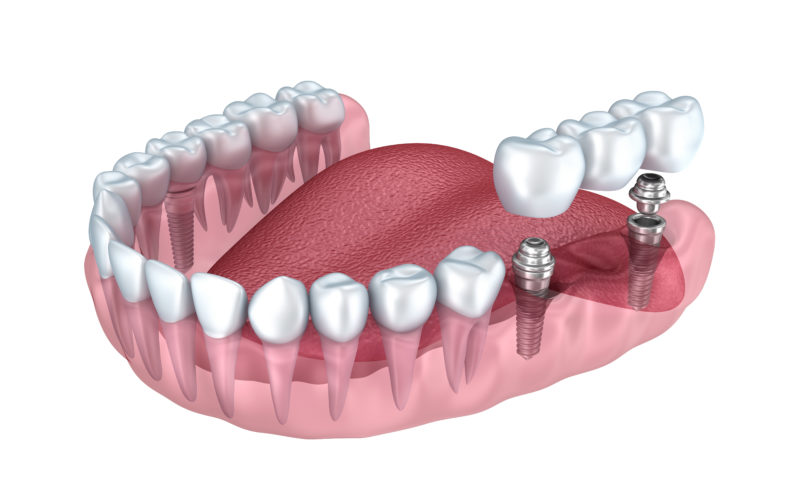 3d lower teeth and dental implant transparent render isolated on white